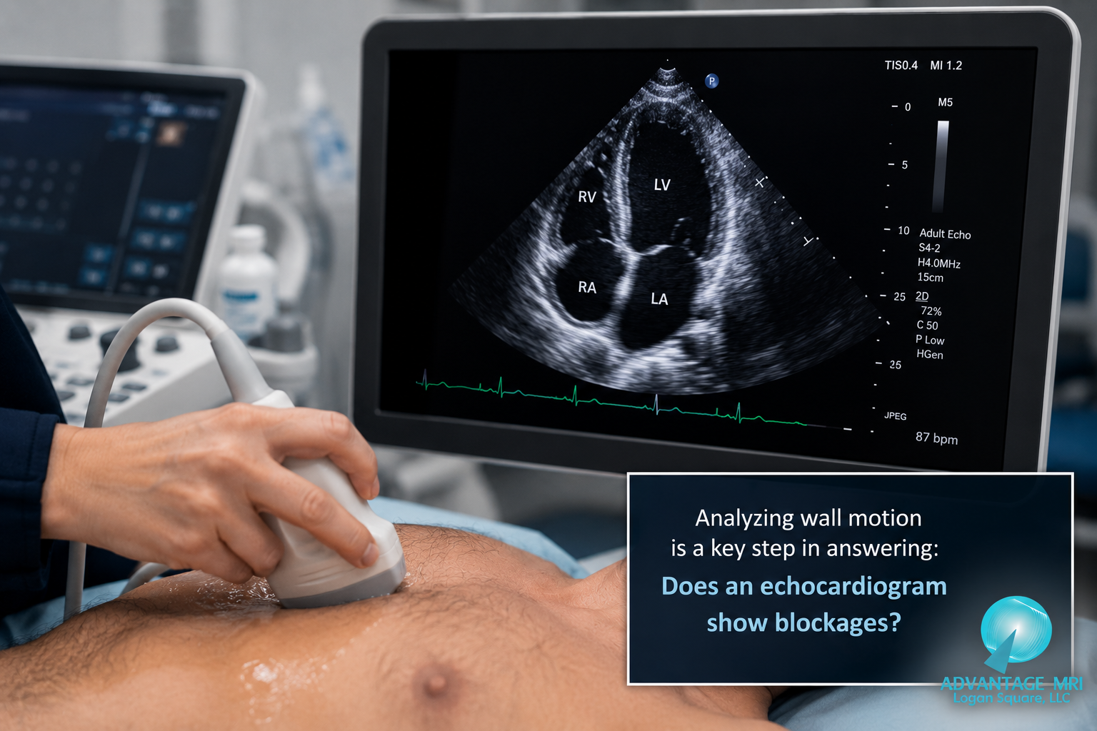 does an echocardiogram show blockages